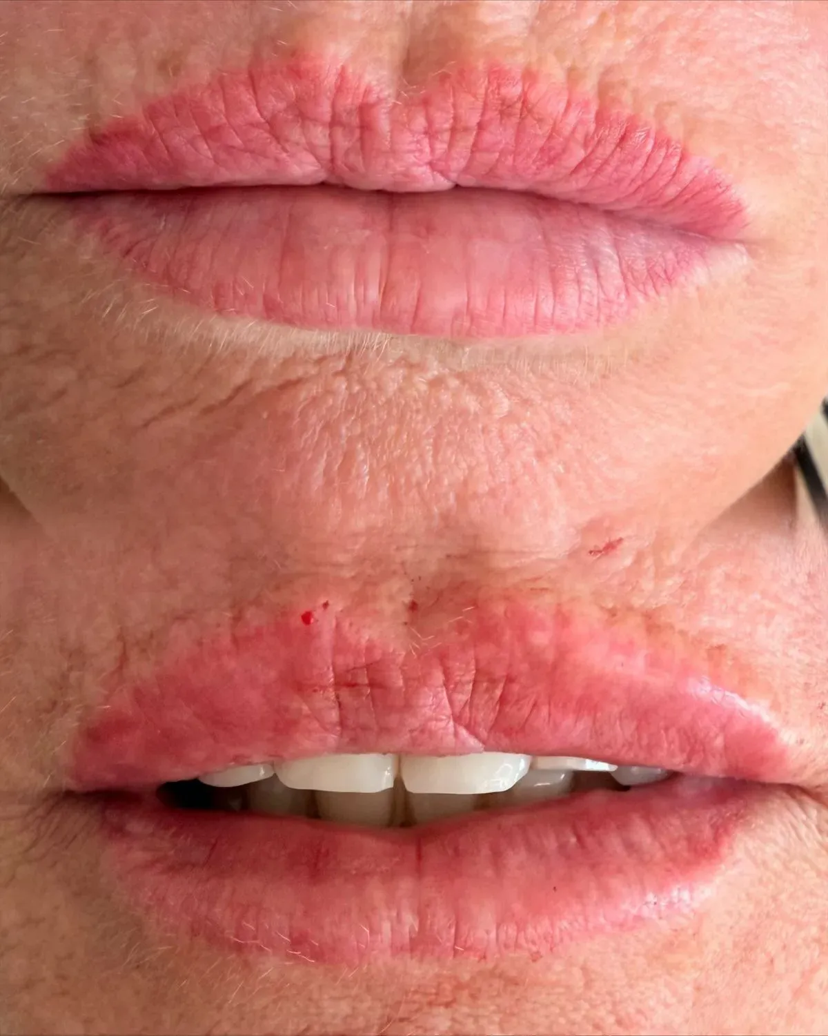 Botox Treatments
