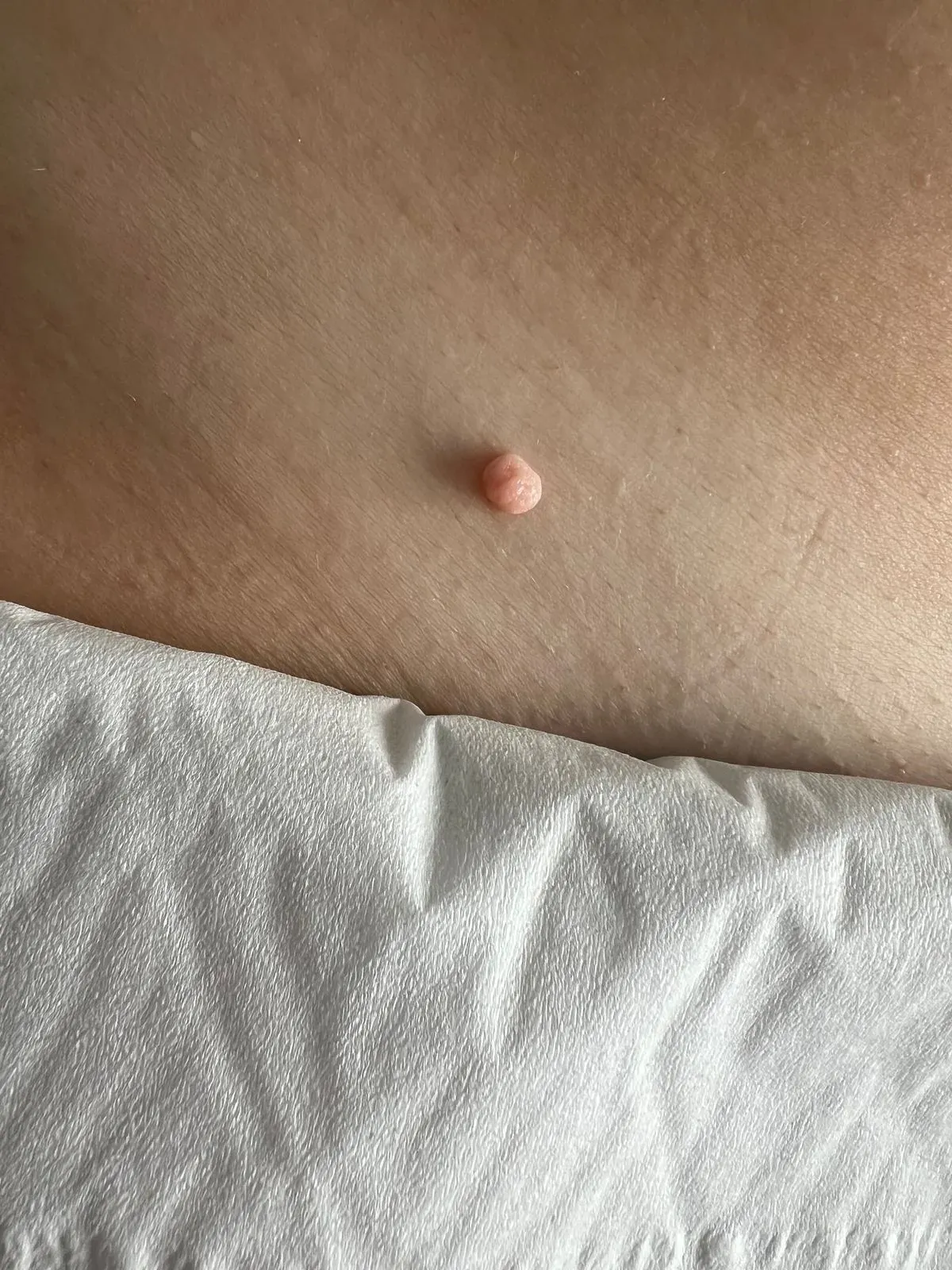 Skin-tag removal  image background image