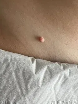 Skin-tag removal  image