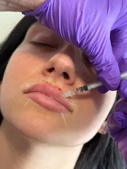 Skin-tag removal  image