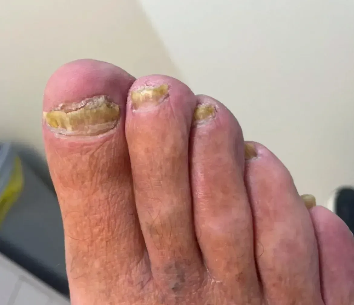 Diabetic Foot Care