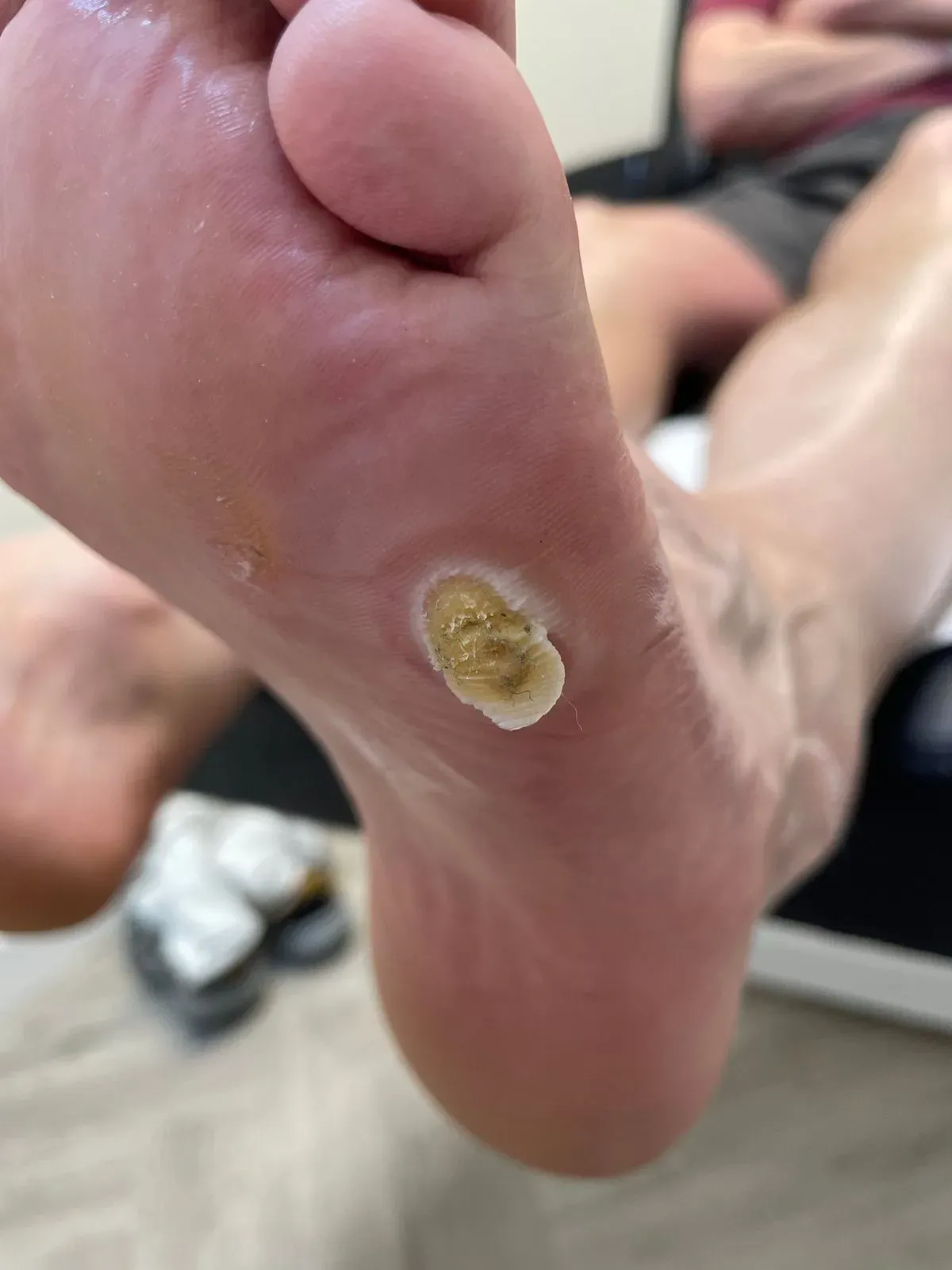 Athlete's Foot Management