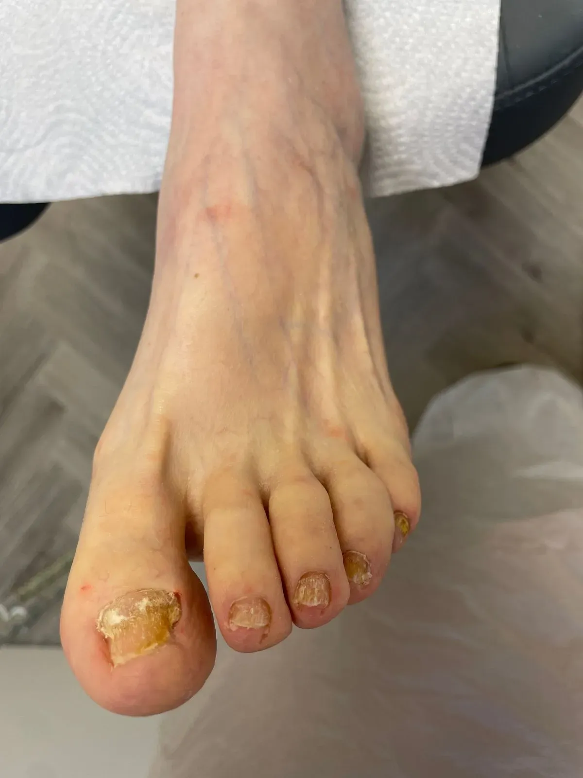 Fungal Nail Treatments