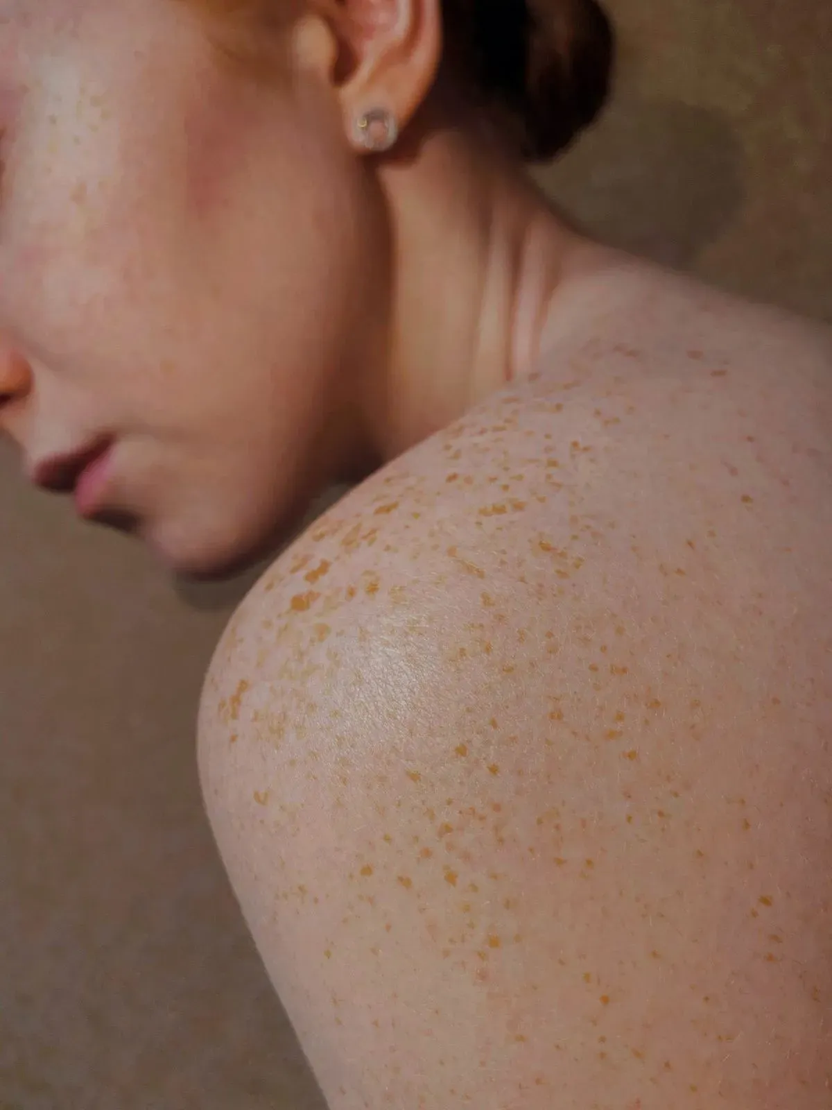 Collagen induction therapy in Blaenau-Gwent, South Wales, UK: medical microneedling treatment