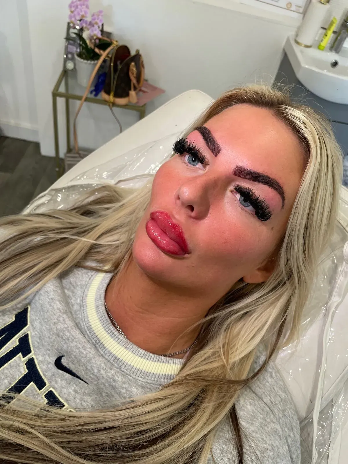 Advanced Dermal Fillers