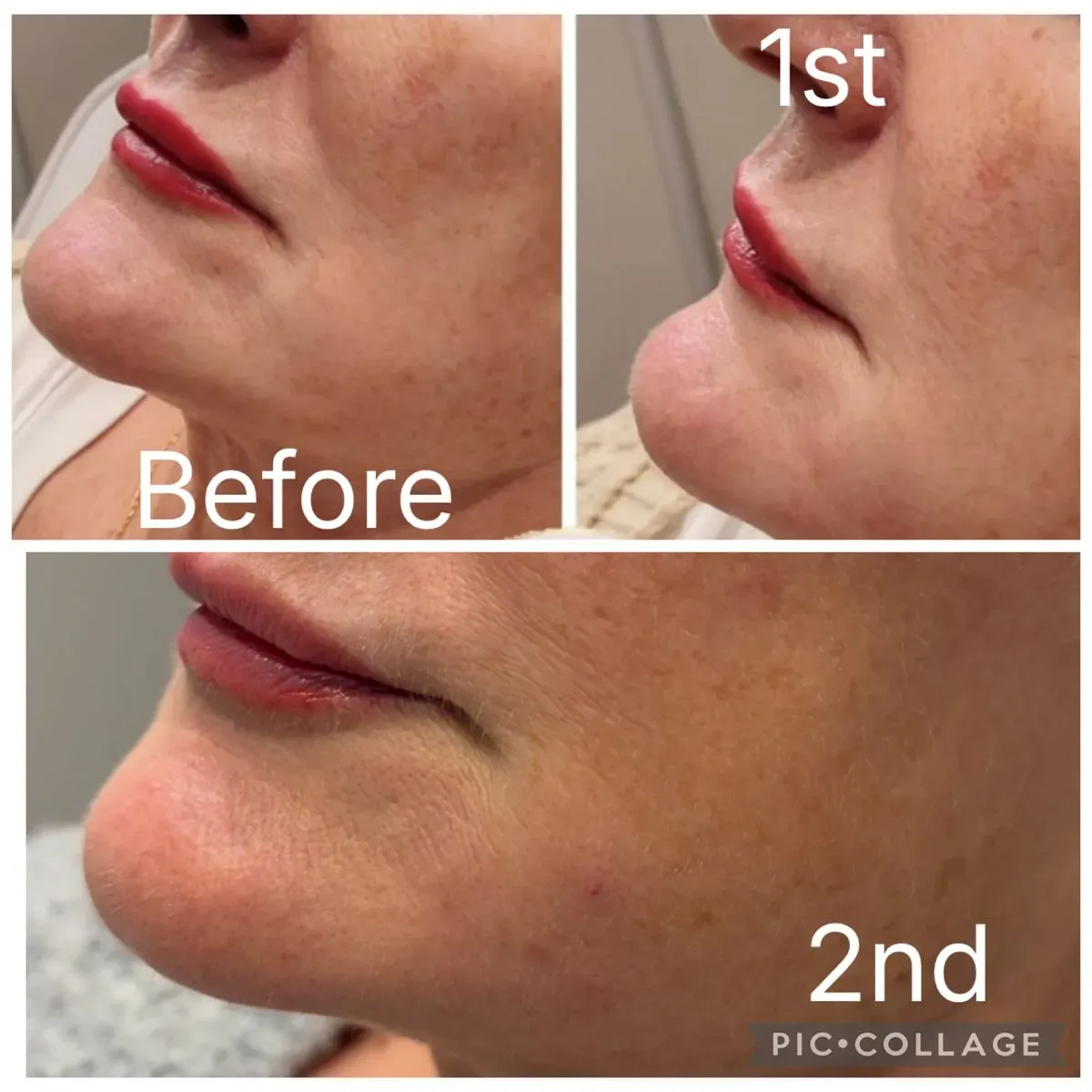 Acne and scar treatment image background image