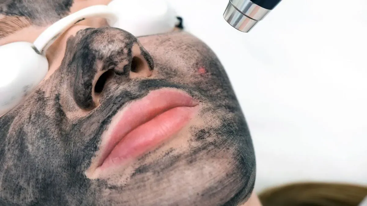 Radiant skin following successful carbon peeling treatment