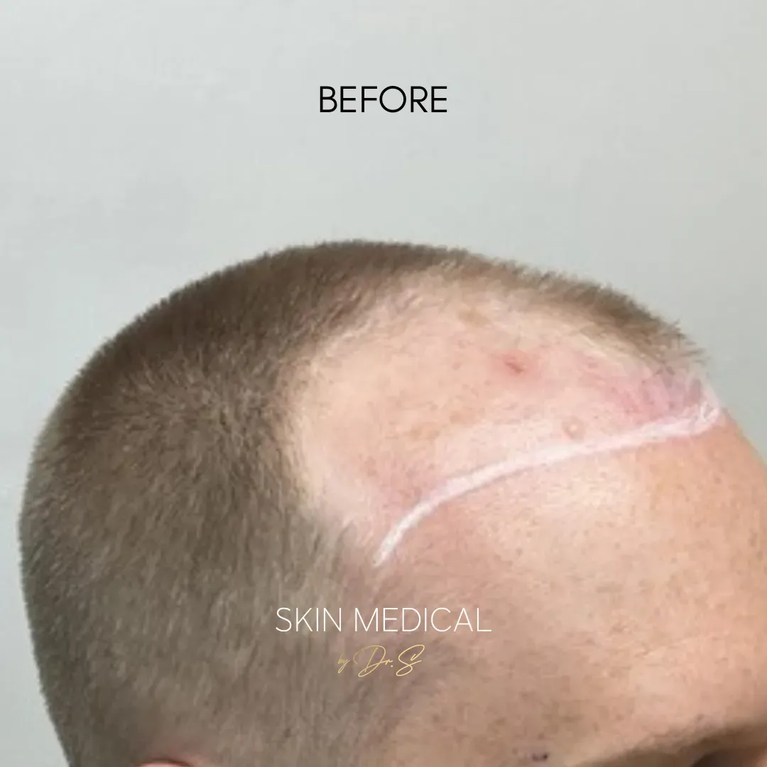 Before Hair Transplant