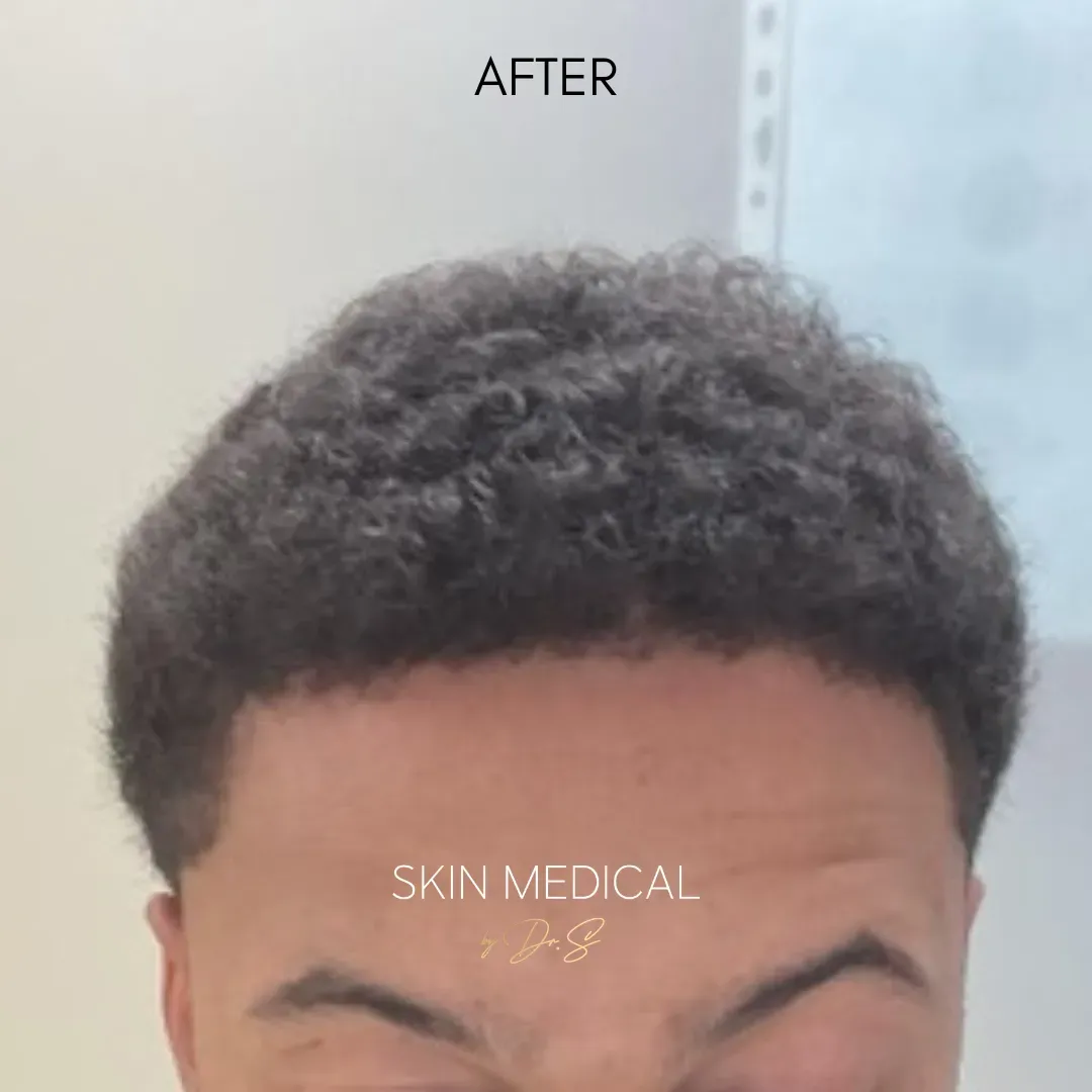 After Hair Transplant