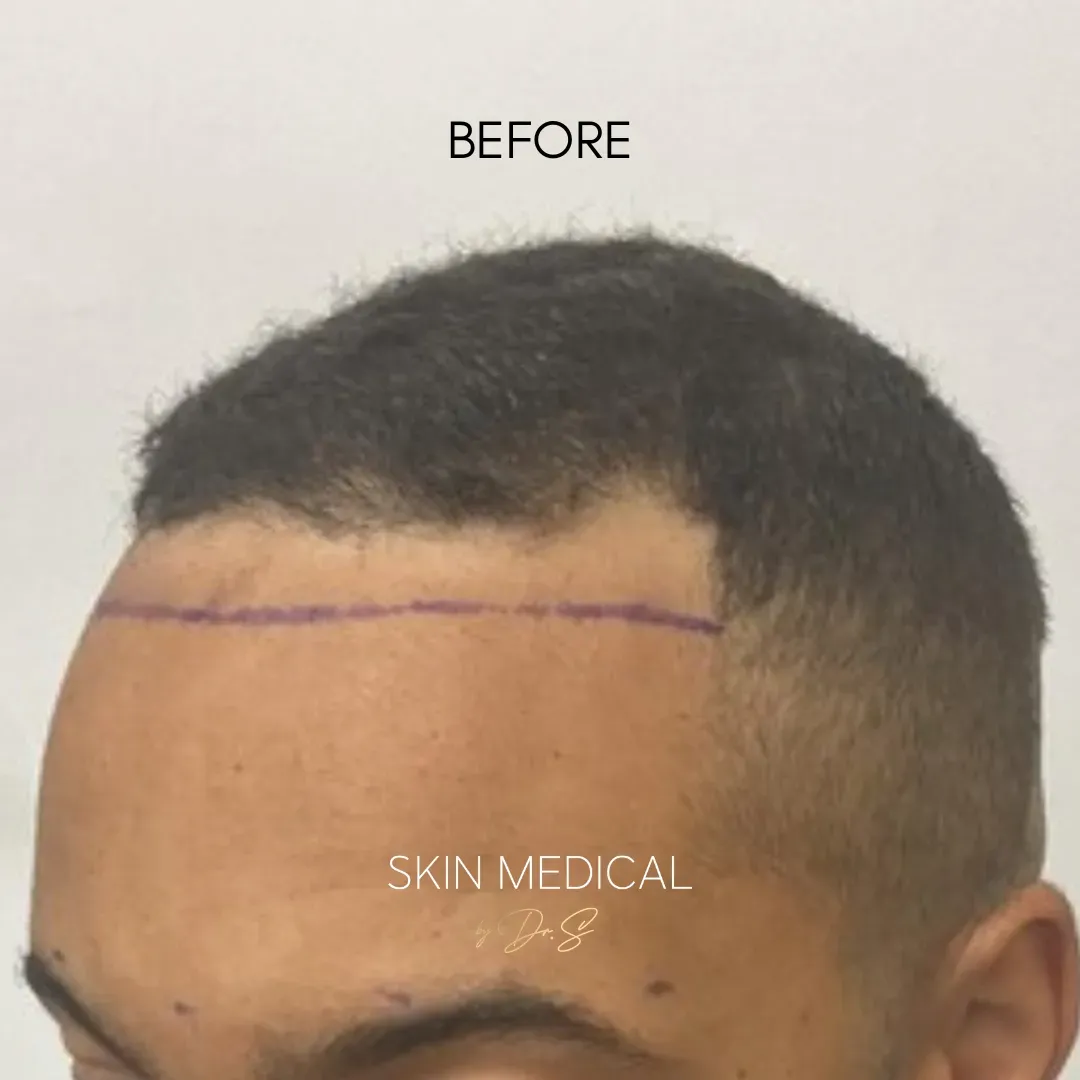 Before Hair Transplant