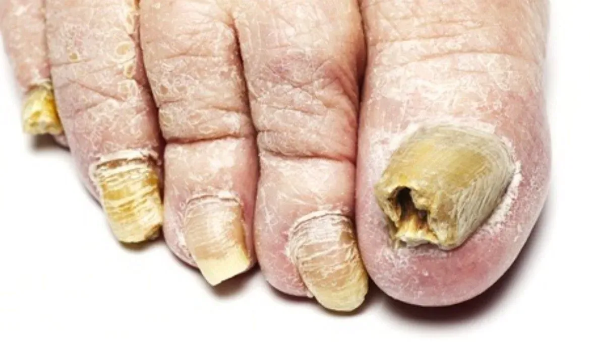 Fungal nail treatment image background image