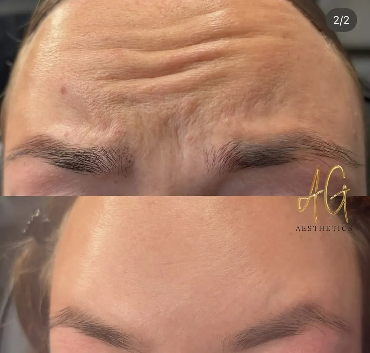 Botulinum Toxin Injections image background image
