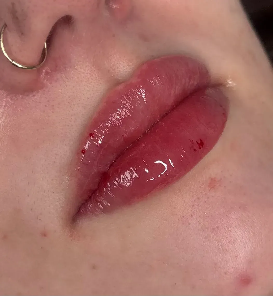 Dermal Fillers image background image