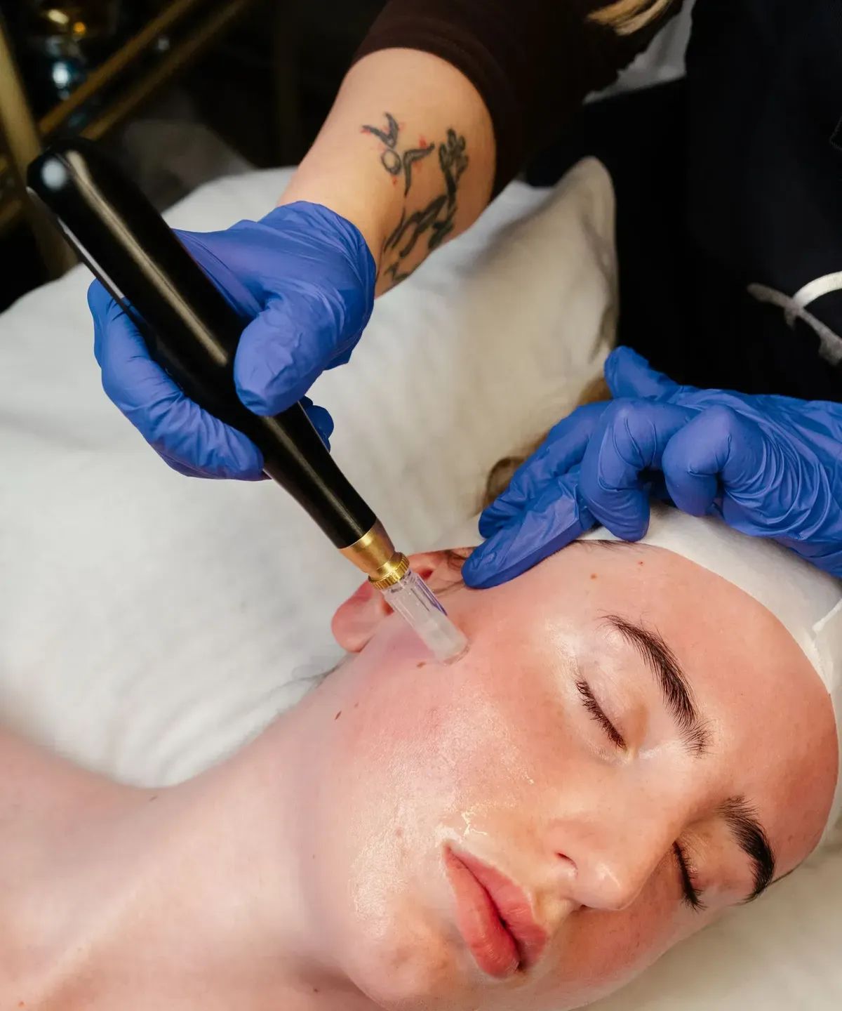 Chemical Peels