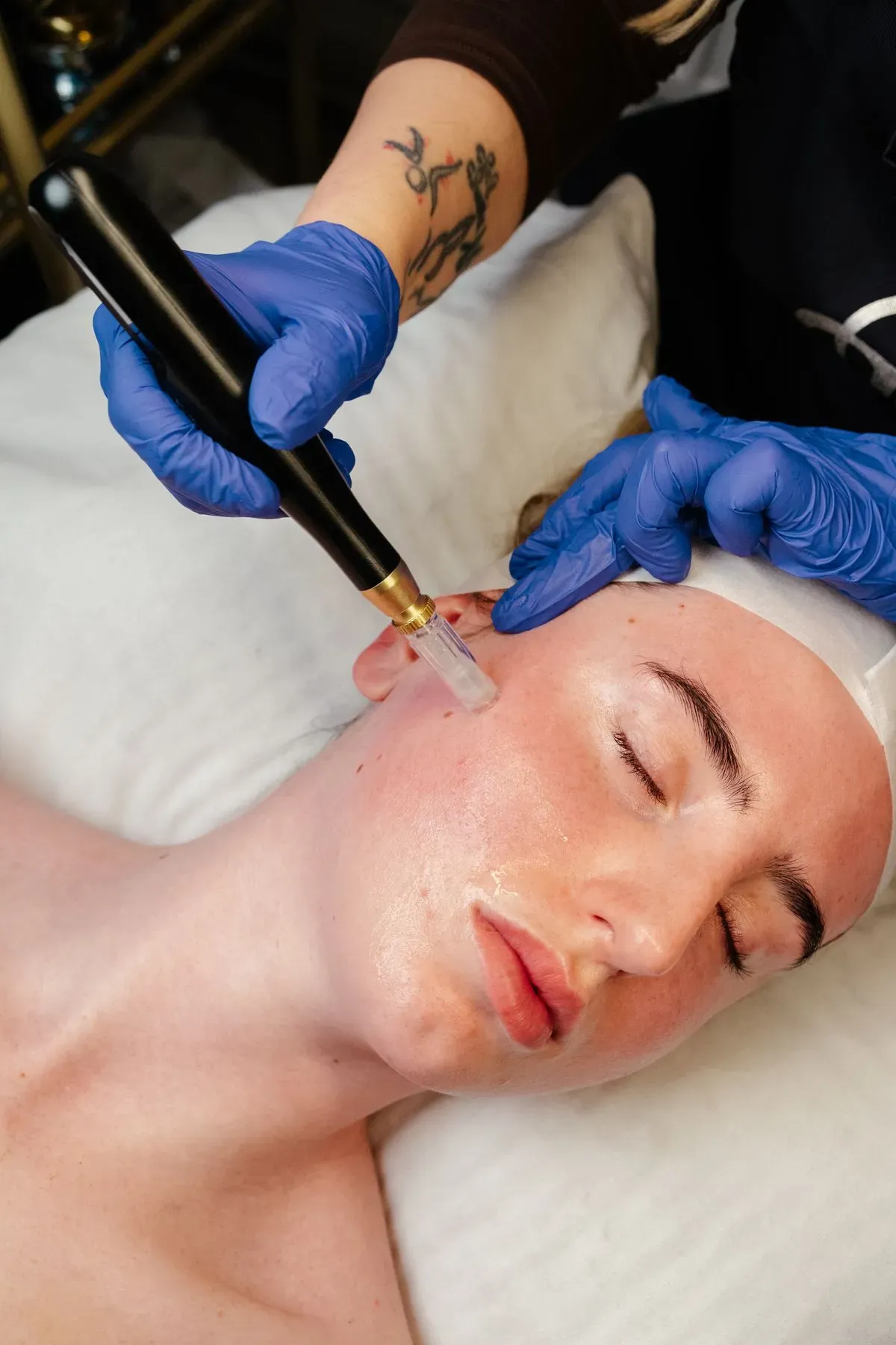 Microdermabrasion