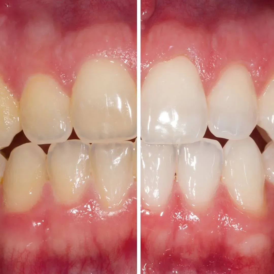 Before and after teeth whitening in Chester