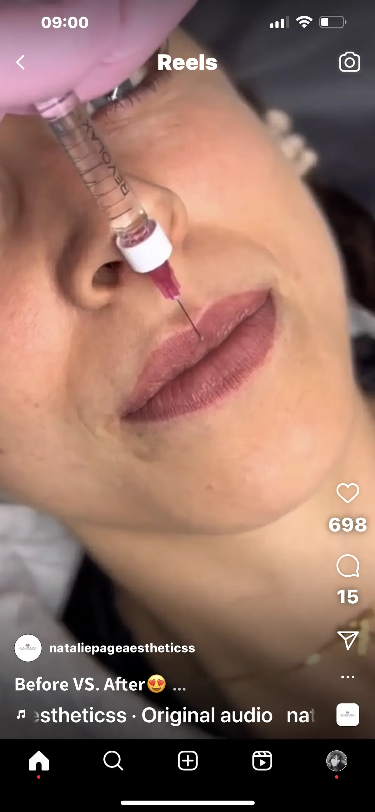 Dermal Fillers