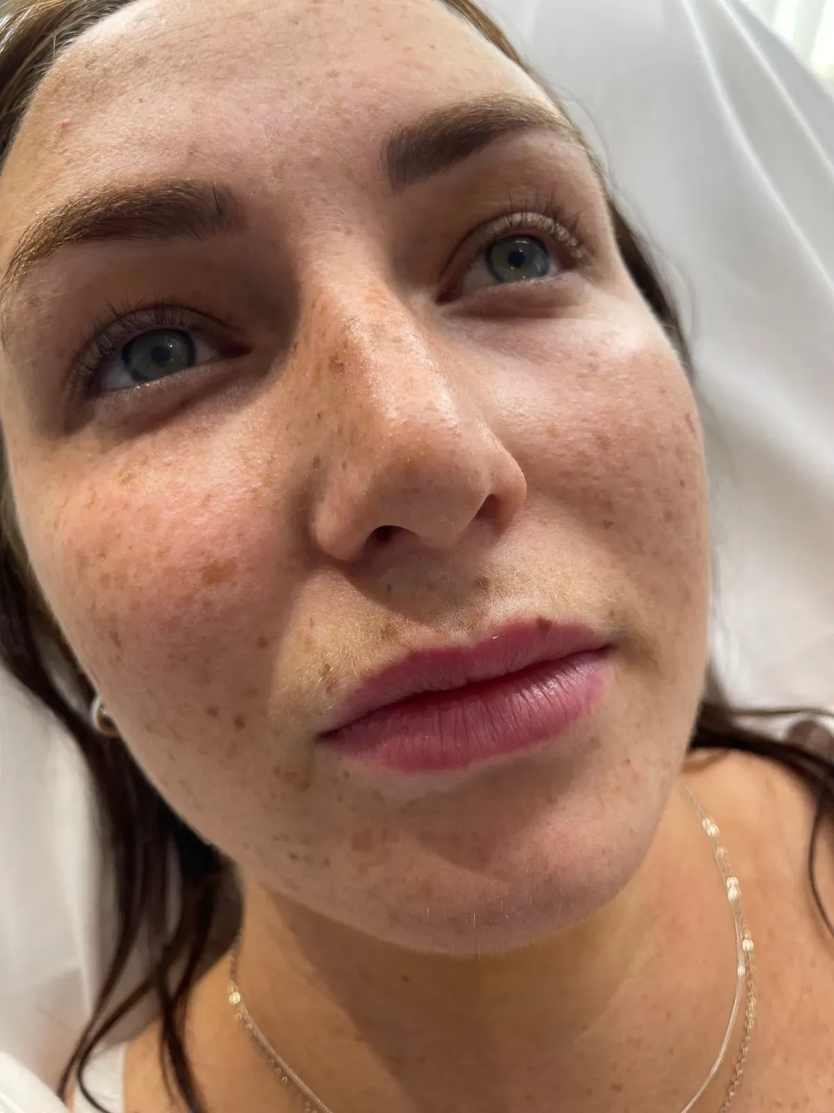 Chemical Peels