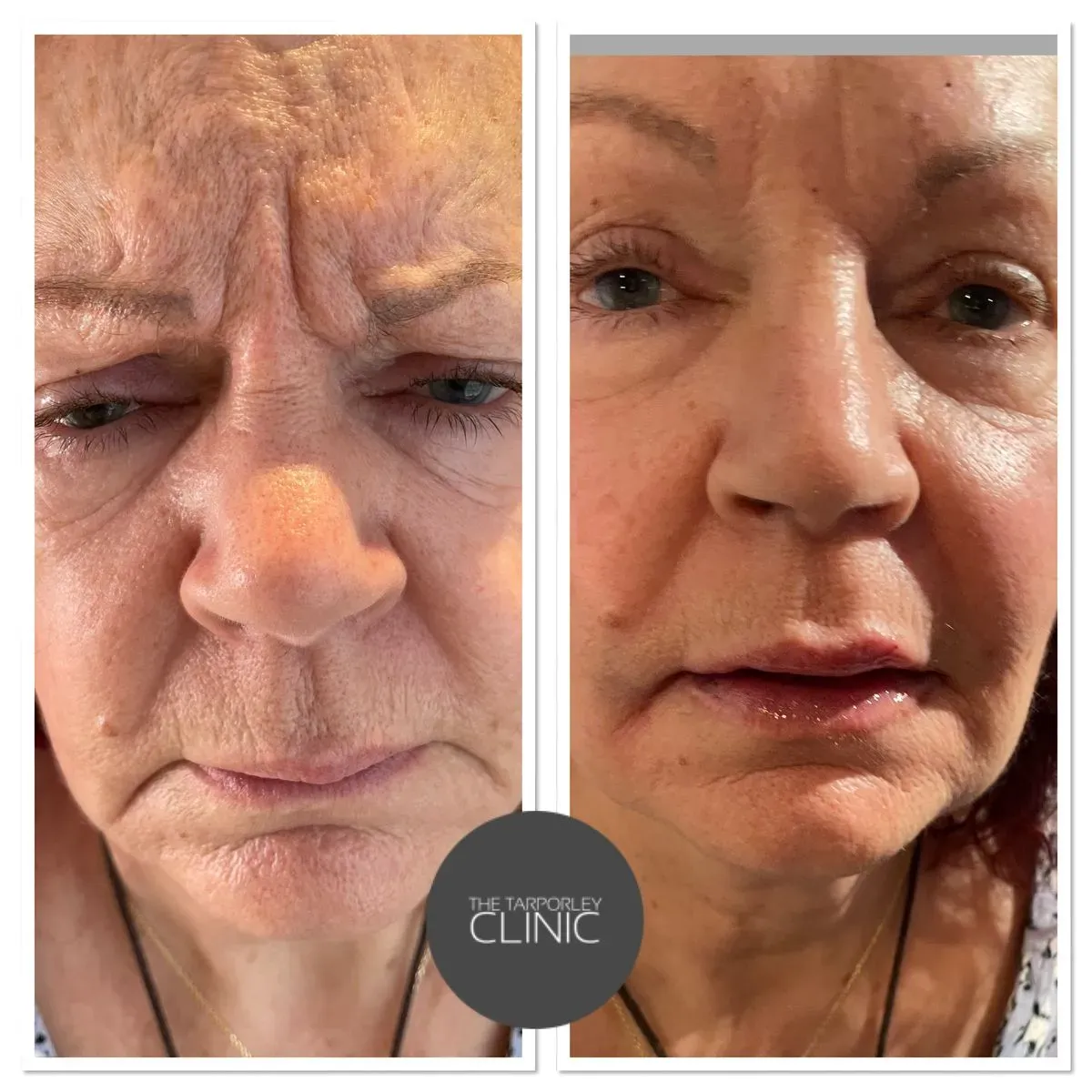 Micro Needling