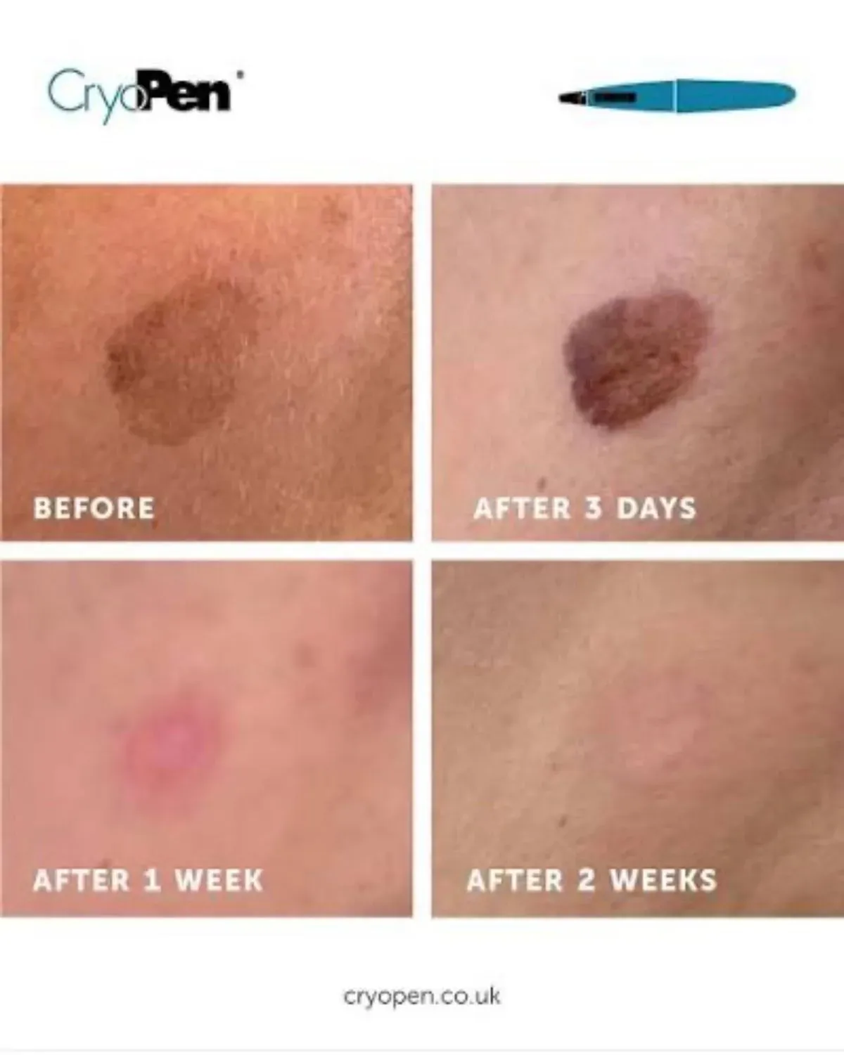 Skin lesion removal image background image