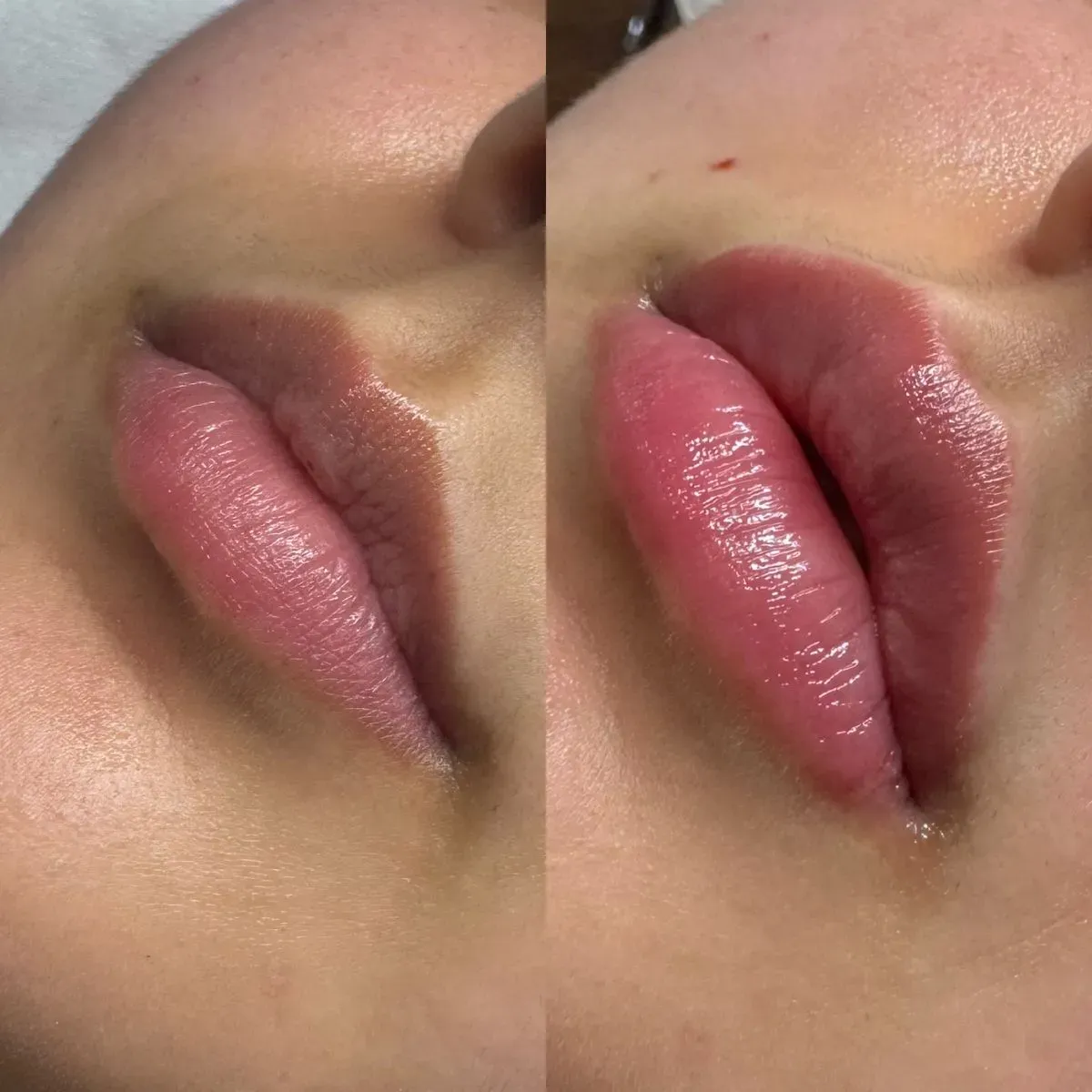 Dermal Fillers image background image