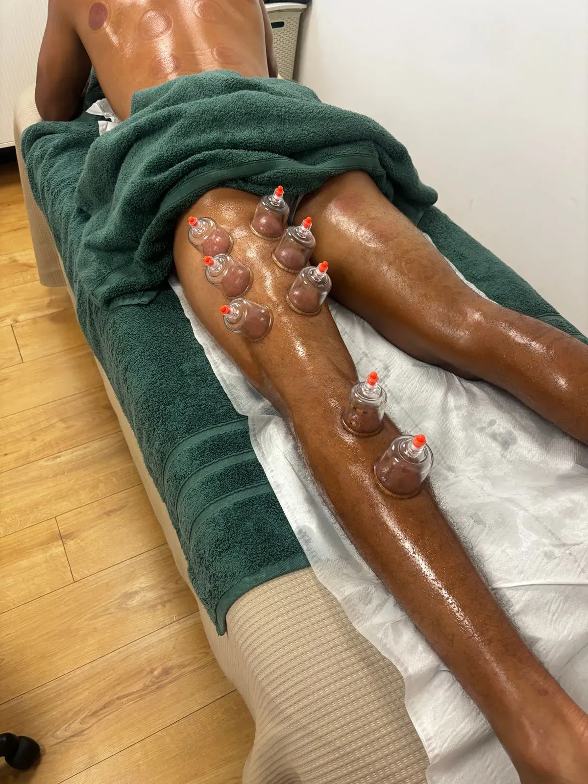 Cupping Therapy