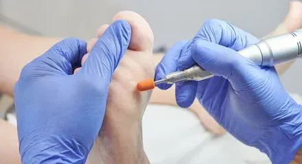 Corn and Callus Removal image background image