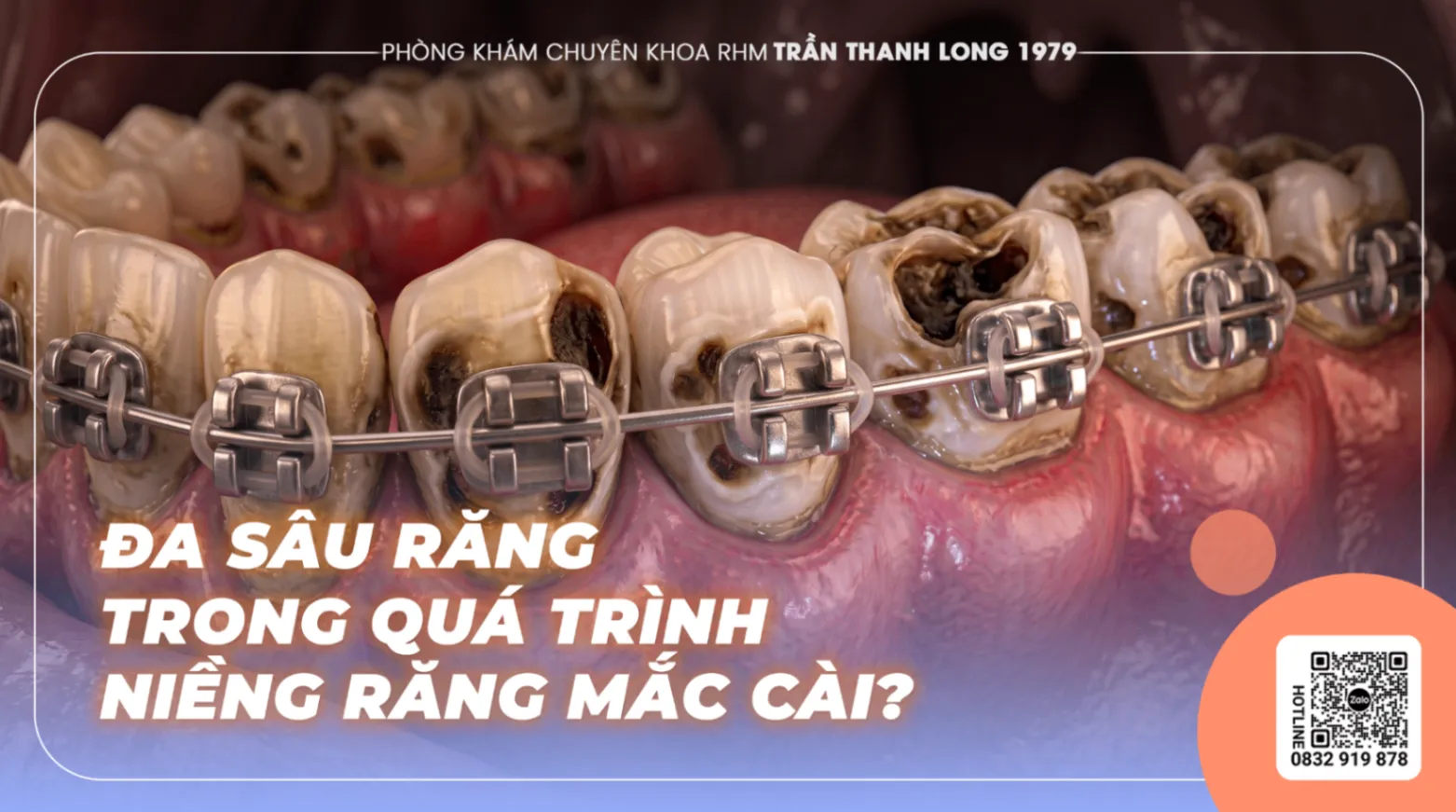 80% Người Niềng Răng Mắc Cài Đều Sâu Răng Nếu Không Chú Ý Đến Những Điều Này!