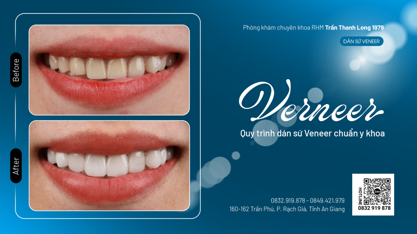 Mổ Xẻ Chi Tiết Quy Trình Dán Sứ Veneer Chuẩn Y Khoa