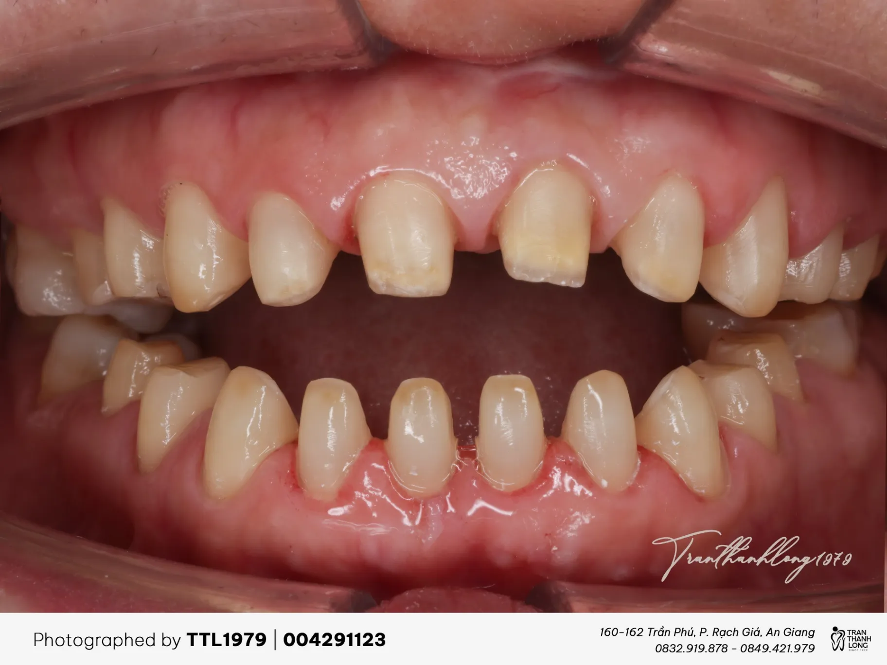 Kết quả mài răng - 004291123