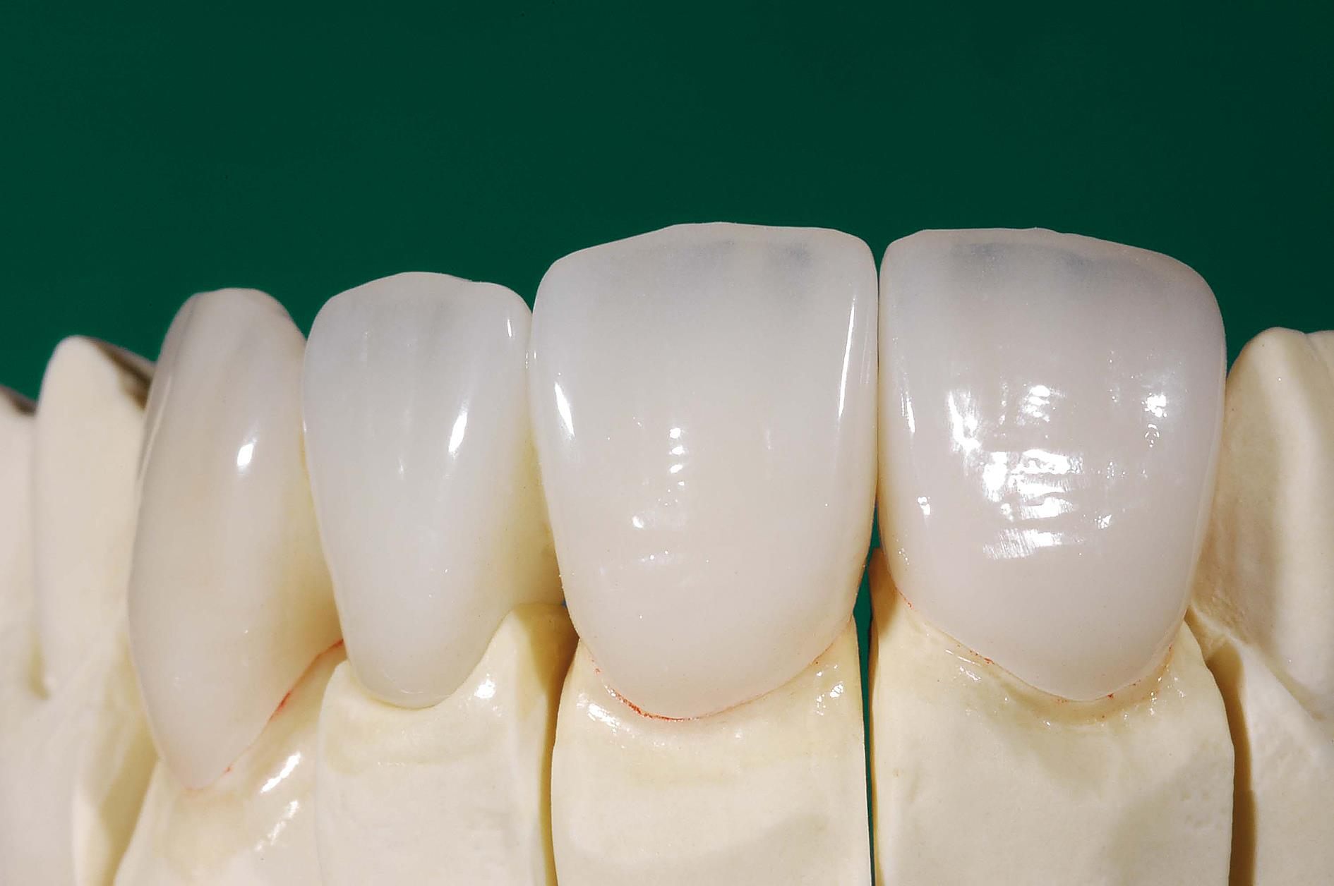 Veneer sứ Emax