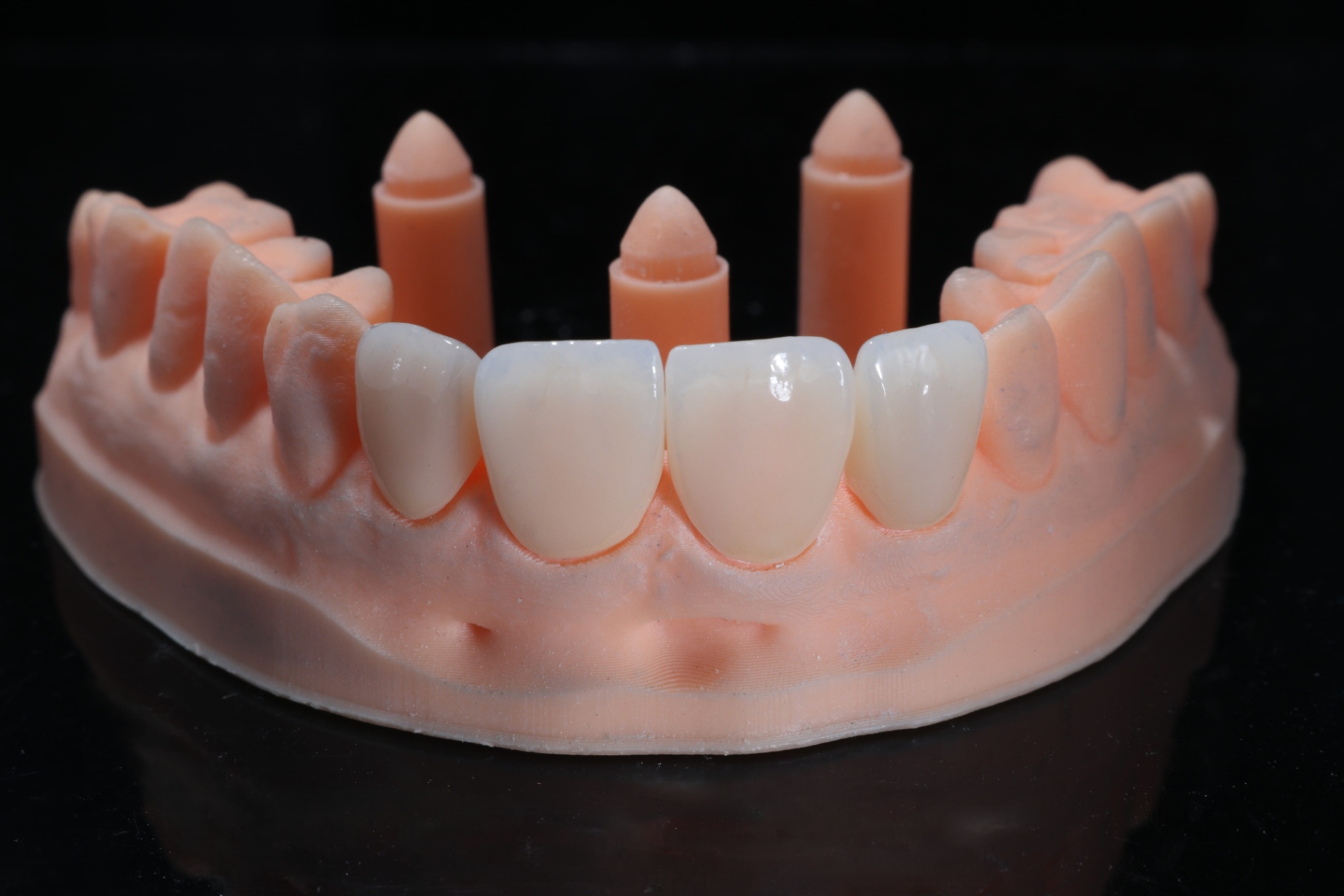 Veneer sứ Zirconia