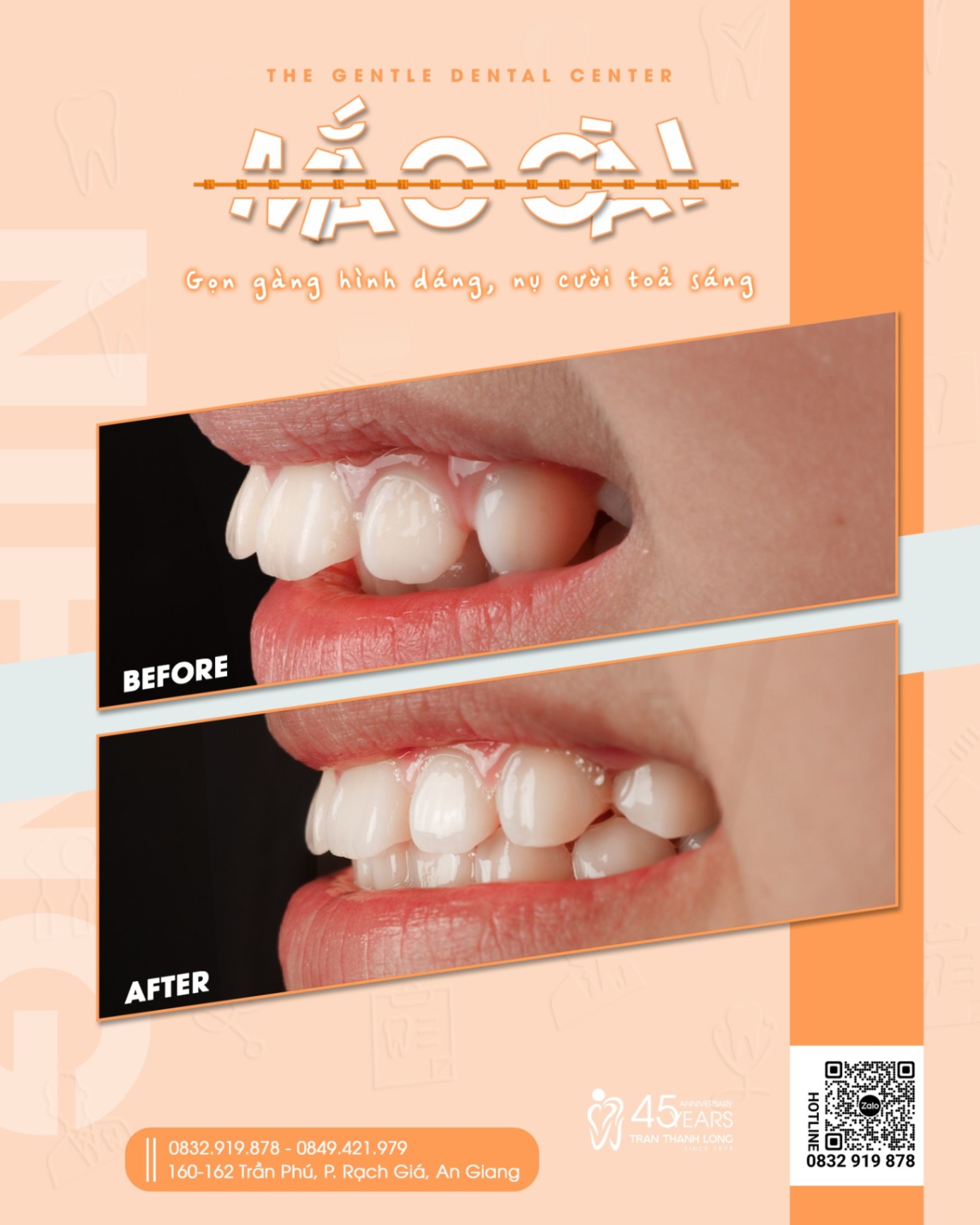 Niềng răng mắc cài