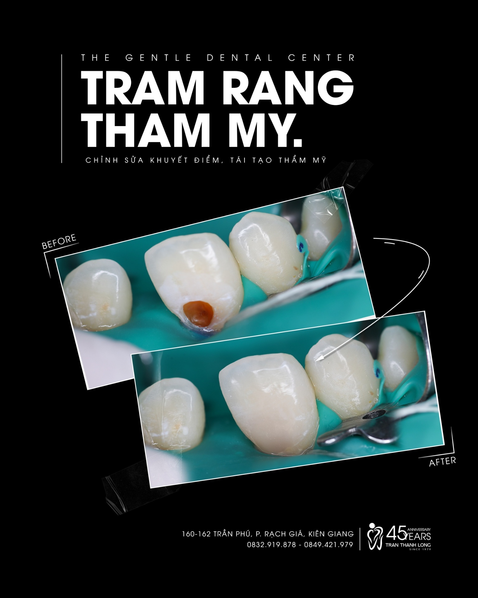 Trám răng thẩm mỹ