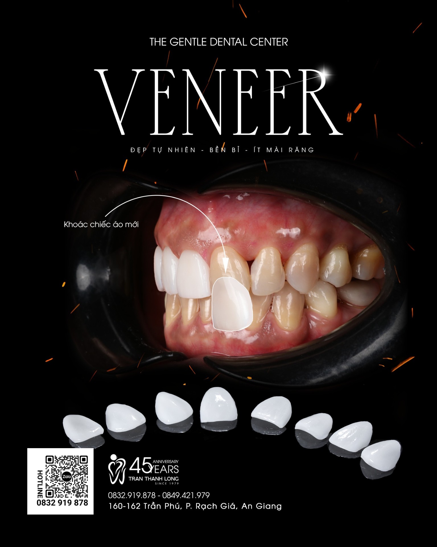 Dán sứ Veneer