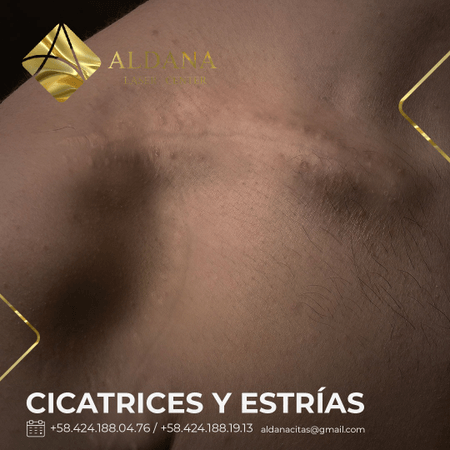 Cicatrices y estrías 