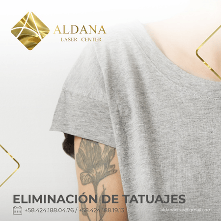Eliminación de Tatuaje