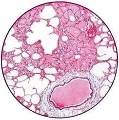 Plate showing microscope view of lung cells poisoned from phosgene