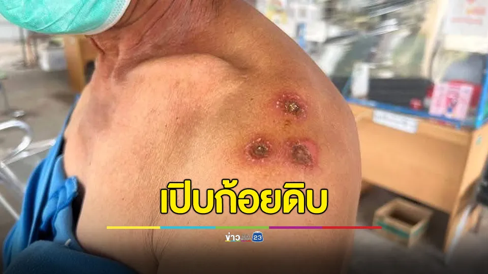พบชายต้องสงสัย ติดเชื้อแอนเเทรกซ์ หลังเปิบก้อยดิบ