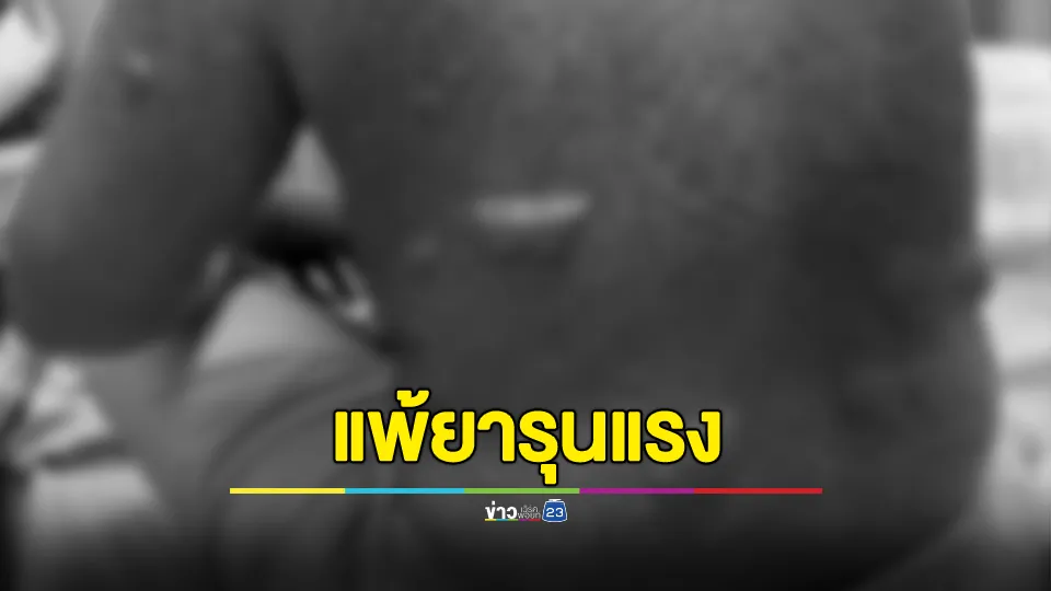 ผู้เสียหาย 2 ราย ร้องหมอวินิจฉัยผิดพลาด จนเกิดอาการแพ้ยารุนแรง หวิดตาบอดทั้ง 2 ข้าง