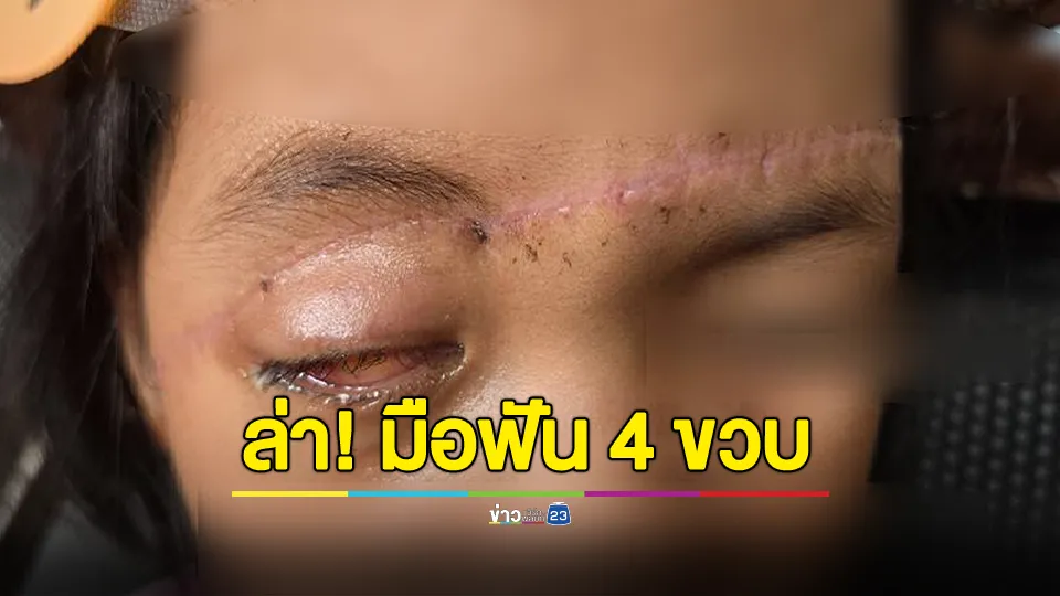 แม่ร้อง! ลูกสาว 4 ขวบ ถูกคนร้ายฟันสาหัสตาบอด- เย็บกว่า 50 เข็ม