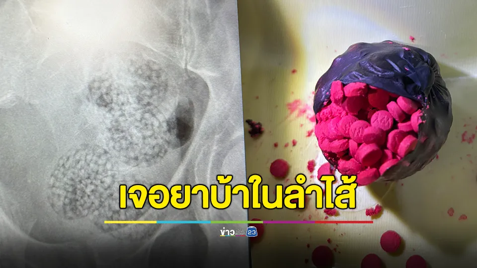 ชายออสเตรียชักเกร็ง หมอผงะ! เจอยาบ้าซ่อนในลำไส้
