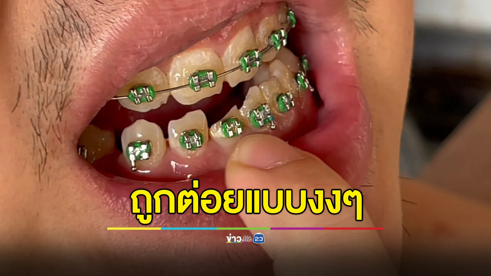 หนุ่มงงจอดรถติดไฟแดง เจอใครไม่รู้ต่อยล้ม ฟันหัก 2 ซี่