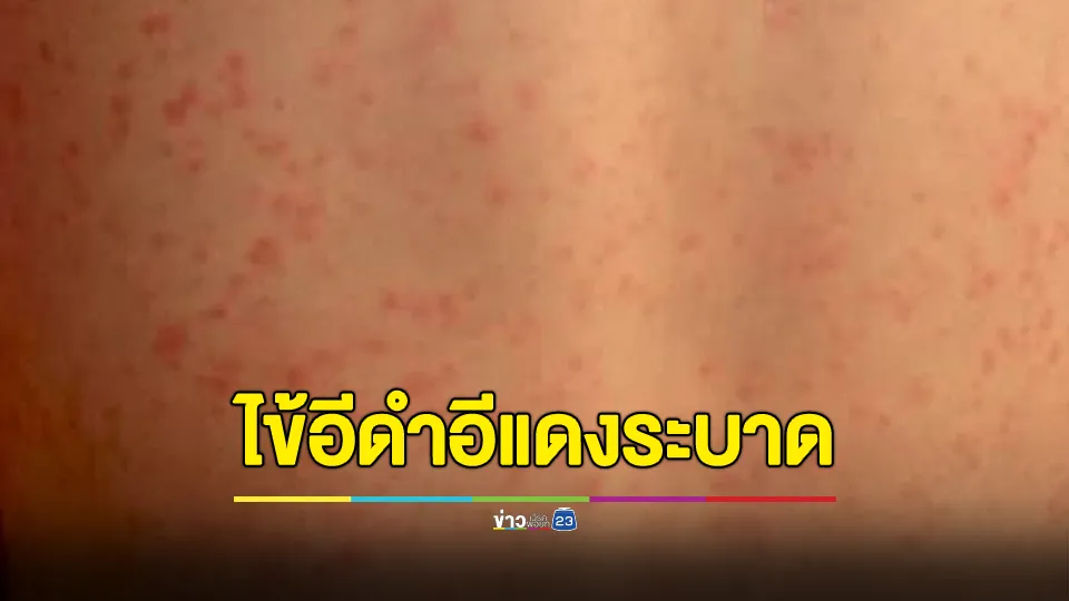 เตือน ไข้อีดำอีแดงระบาด เผยบางโรงเรียนต้องหยุดเรียน!