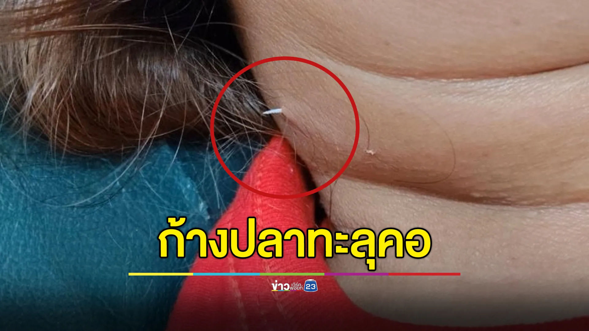 อุทาหรณ์! ทานปลาต้องระวัง ก้างปลาติดคอแทงจนทะลุออกมา