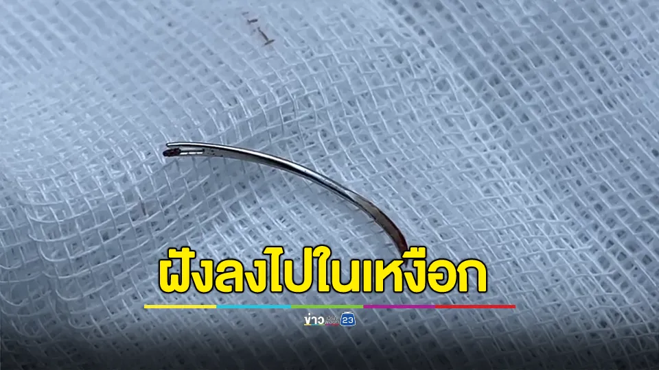 สาวมีอาการเจ็บเสียดในช่องคอ พบคล้ายขอเบ็ดยาว 3 ซม.ในปาก