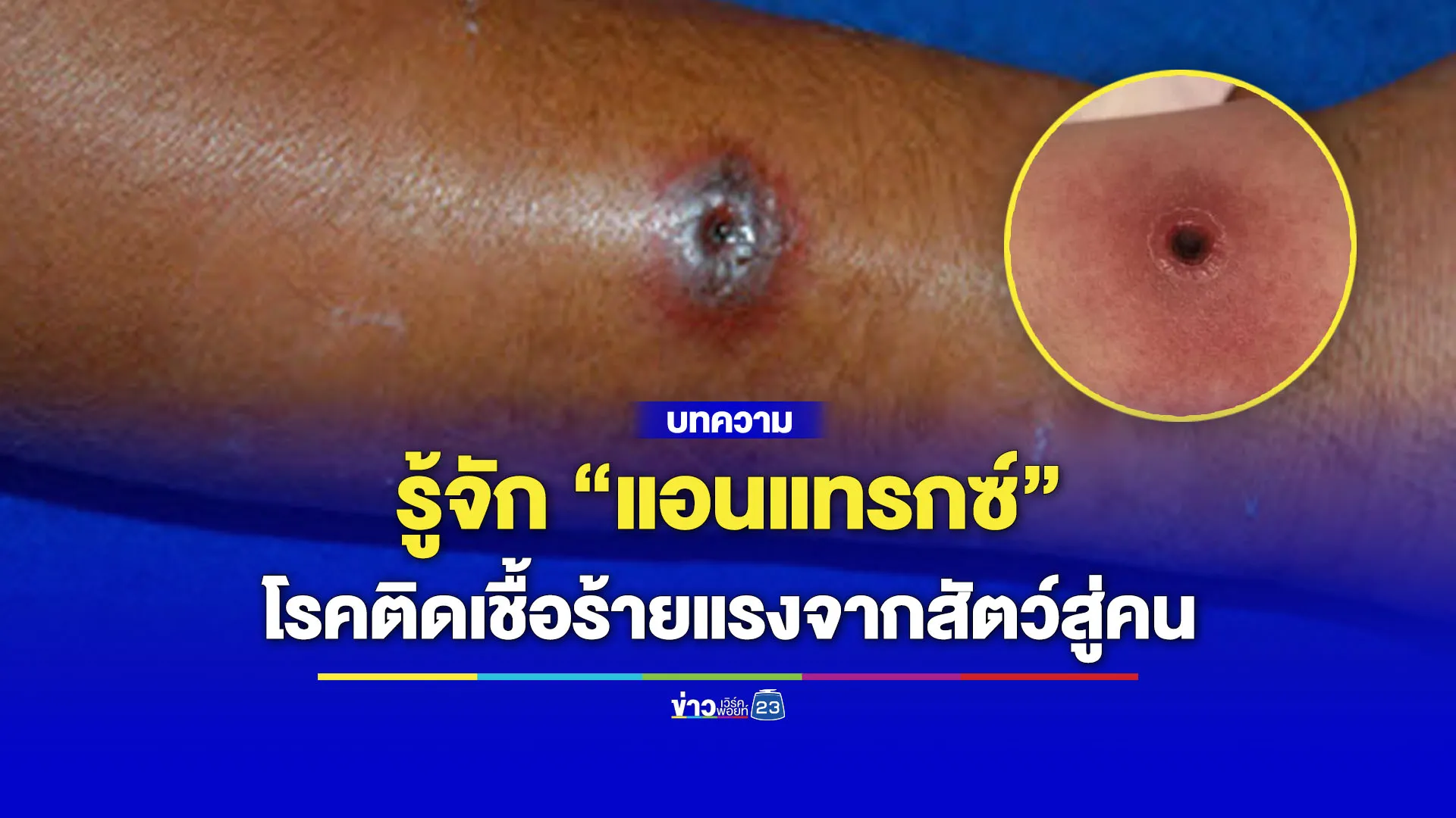 รู้จัก “แอนแทรกซ์” โรคติดเชื้อร้ายแรงจากสัตว์สู่คน