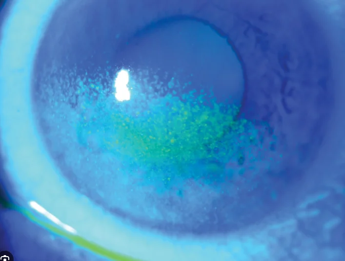 Understanding Neurotrophic Keratitis: Causes, Stages, and Why Corneal Nerve Health Matters