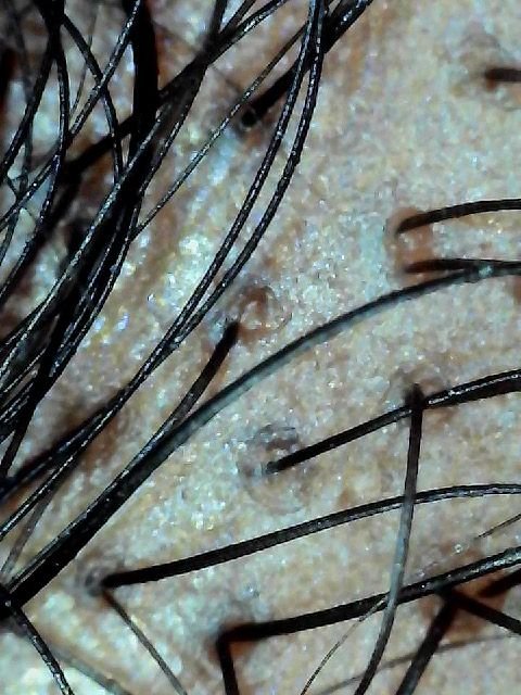 Understanding Alopecia: Types, Causes, and Solutions for Hair Loss