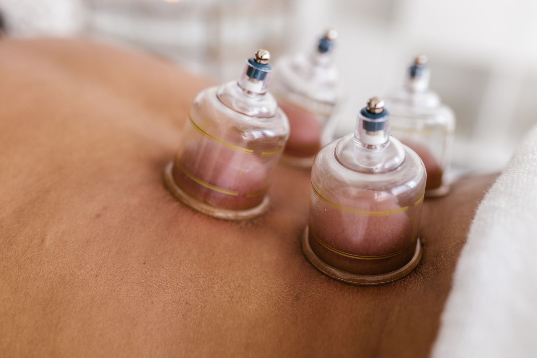 Cupping Looks Painful, But Is It? Debunking the Myths Around This Ancient Healing Therapy